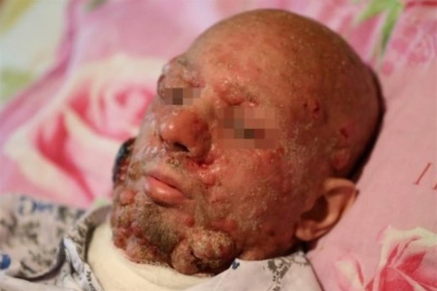 Волгоградцев просят помочь мужчине, который покрылся чешуей из-за редкой болезни Волгоградцев просят помочь мужчине, который покрылся чешуей из-за редкой болезни
