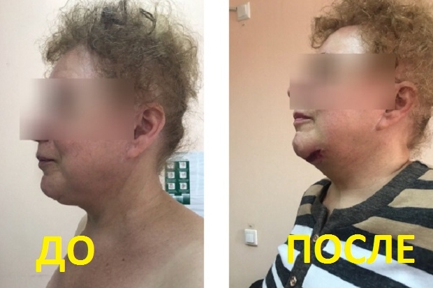 Пенсионерка из Нью-Йорка помолодела в Волгограде на 15 лет, подтянув лицо Пенсионерка из Нью-Йорка помолодела в Волгограде на 15 лет, подтянув лицо